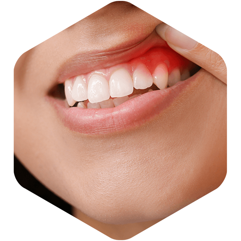 Lip lift in which the infected gum can be noted.